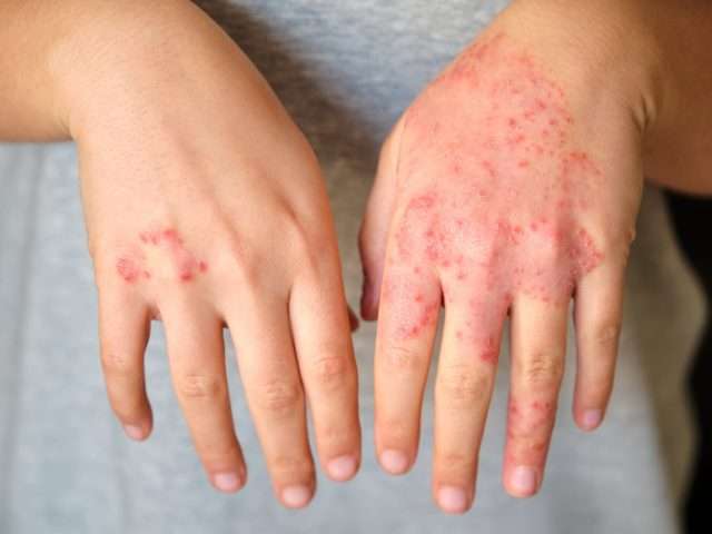 Egzema dłoni – objawy, przyczyny i sposoby łagodzenia zmian skórnych